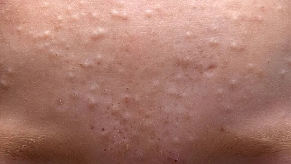 Biểu hiện của mụn đầu trắng