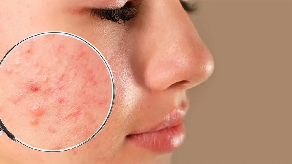 Biểu hiện của nền da đang bị mụn viêm