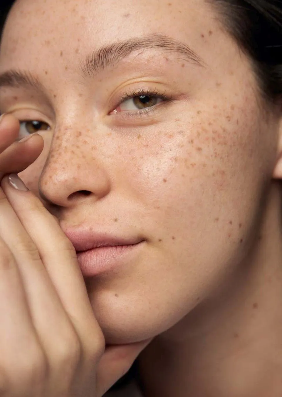 Biểu hiện của nền da bị tàn nhang