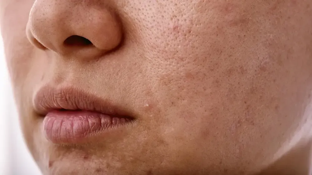 Biểu hiện nền da xỉn màu