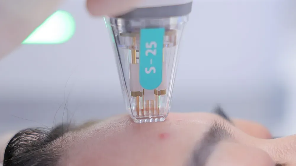 Đầu vi kim của Potenza tác động vào làn da