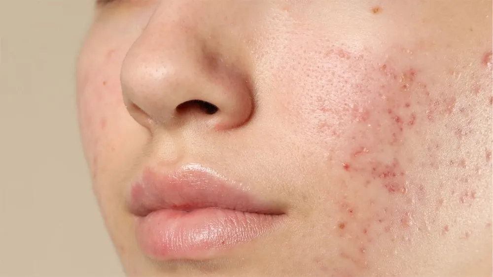 Hàng rào bảo vệ da bị hư tổn khi là da trở nên khô và mụn