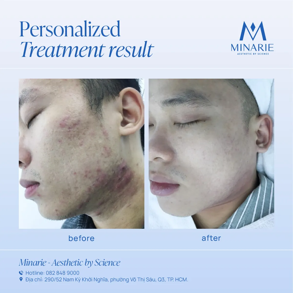 FEEDBACK 45 NGÀY ĐIỀU TRỊ: SẠCH MỤN 7 NĂM