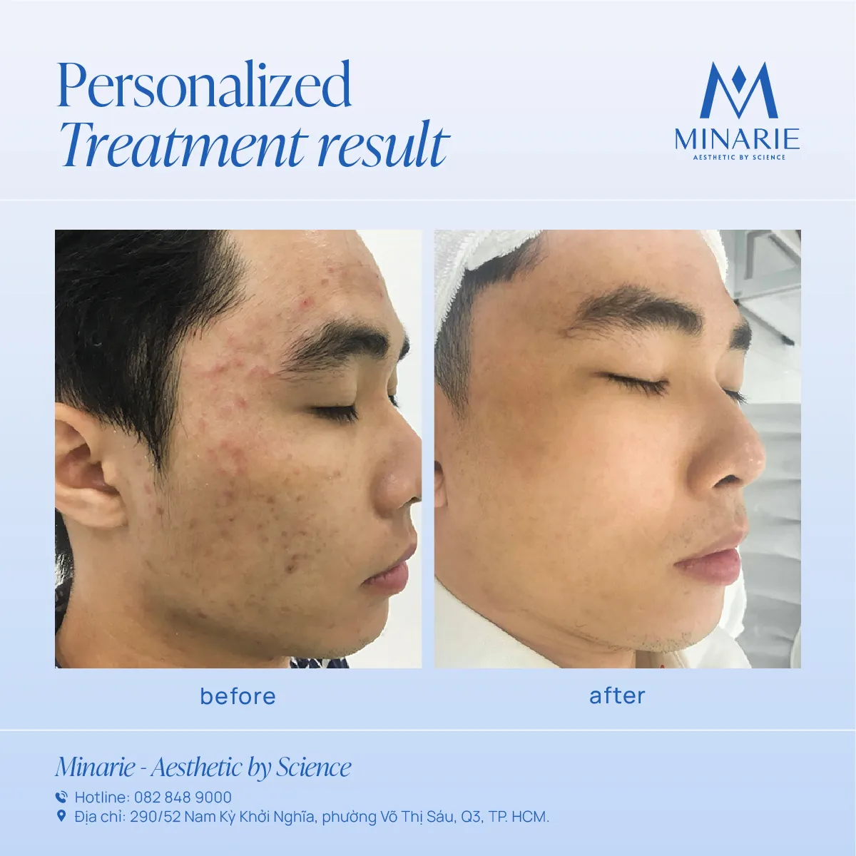 Mụn ẩn - Mụn viêm nặng - Mụn đầu đen - Da sần, sạm - Lỗ chân lông to - Da đổ nhiều dầu - Kết cấu da yếu, nhạy cảm là những vấn đề da mà anh Vinh gặp phải.