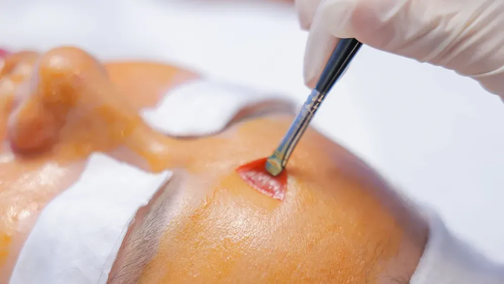 Sử dụng hoạt chất y khoa theo tình trạng da và loại mụn.